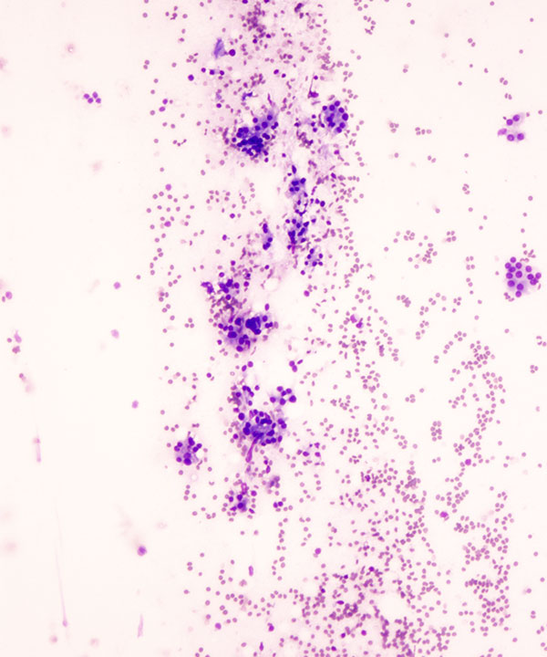 01 : Thyroid Follicular Neoplasm