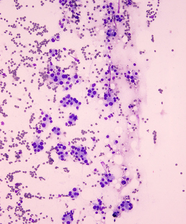 02 : Thyroid Follicular Neoplasm