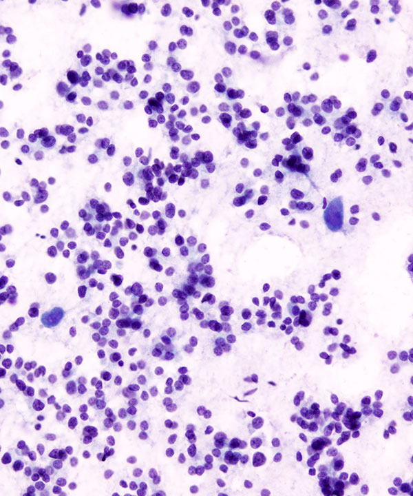 08 : Thyroid Follicular Neoplasm