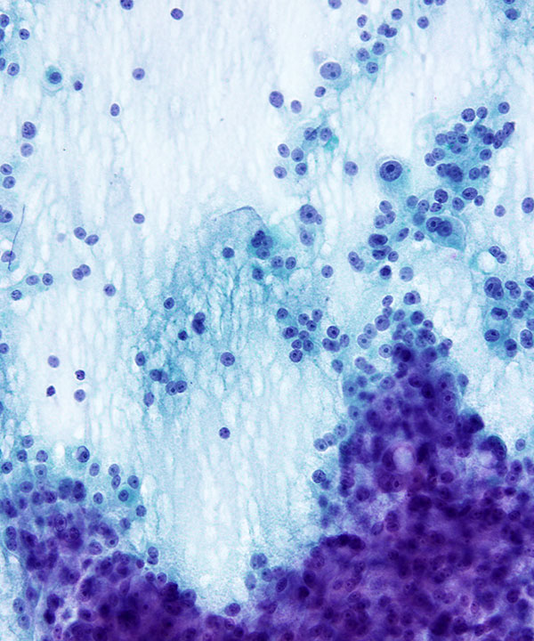 4 : Thyroid Hürthle Cell Neoplasm