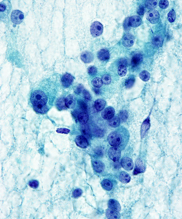 5 : Thyroid Hürthle Cell Neoplasm