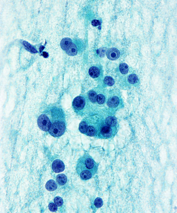 6 : Thyroid Hürthle Cell Neoplasm