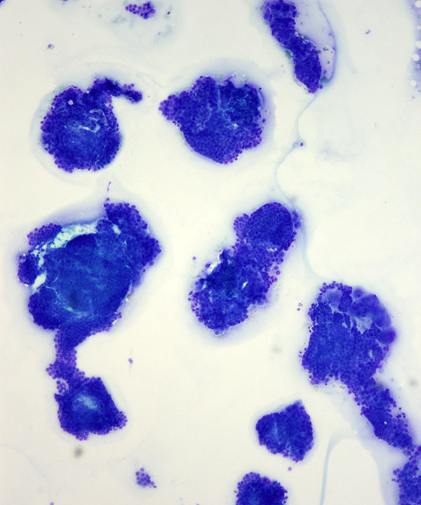 image showing 'Papillary Thyroid Carcinoma'