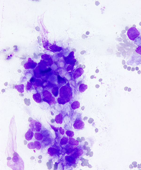 02 : Urine Bladder Adenocarcinoma