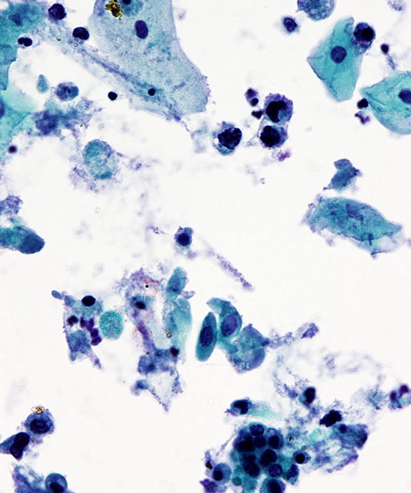 image showing 'High Grade Urothelial Carcinoma'