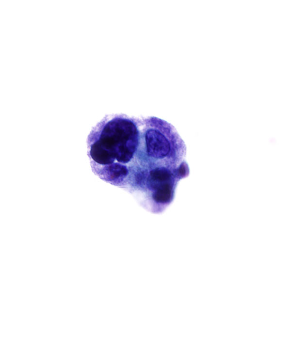 07 : Urine High Grade Urothelial Carcinoma