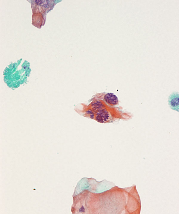 image showing 'Keratinizing Squamous Cell Carcinoma'