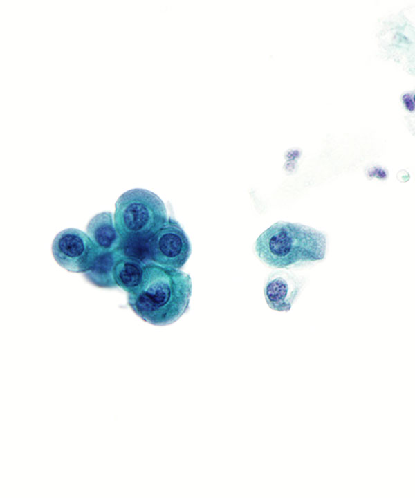 05 : Urine Low Grade Urothelial Carcinoma