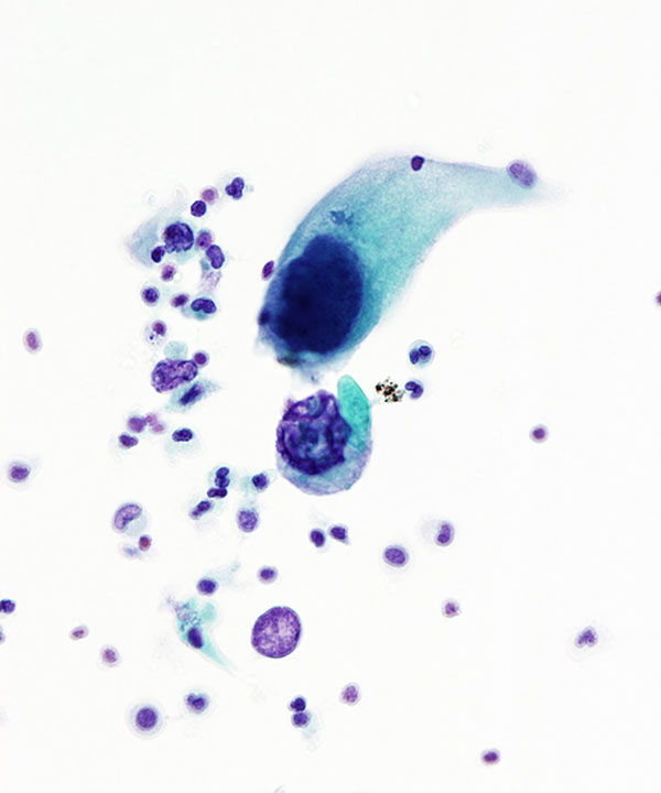 image showing 'Polyoma Virus Infection'