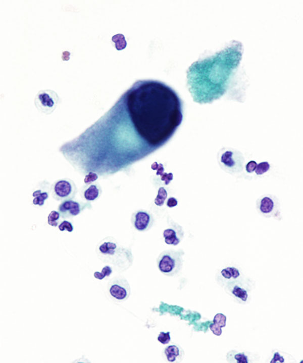 05 : Urine Polyoma Virus Infection