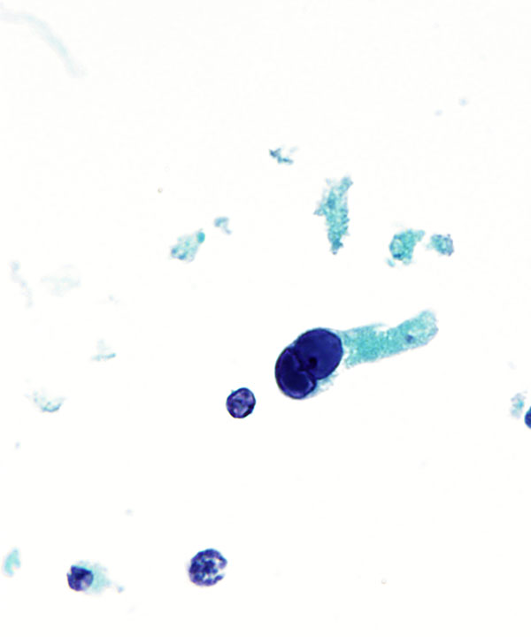 10 : Urine Polyoma Virus Infection