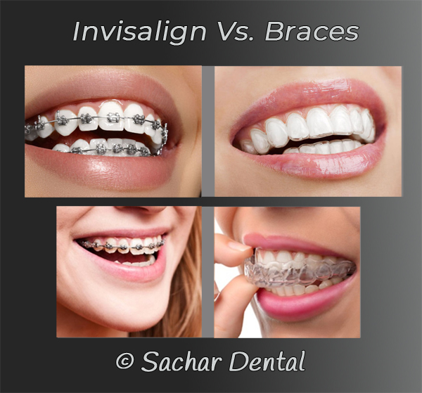 Invisalign vs. Traditional Braces: Which is Best for You?
