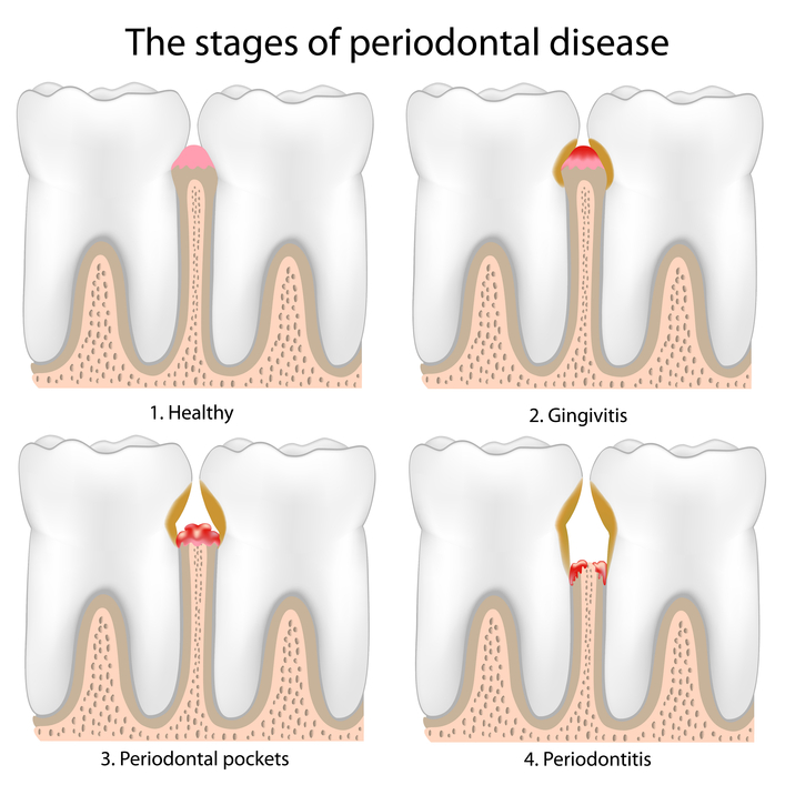 Periodontal Maintenance: Keeping Gum Disease at Bay