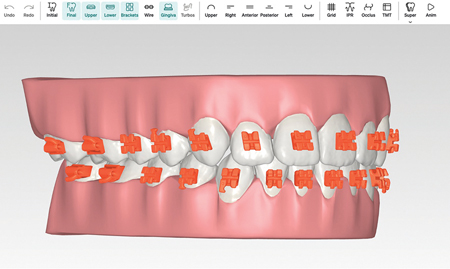 The Future of Orthodontics: 3D Printing and Custom Braces