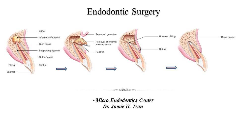 Understanding Endodontic Surgery: When Is It Needed?