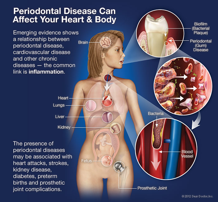 The Link Between Periodontal Disease and Overall Health