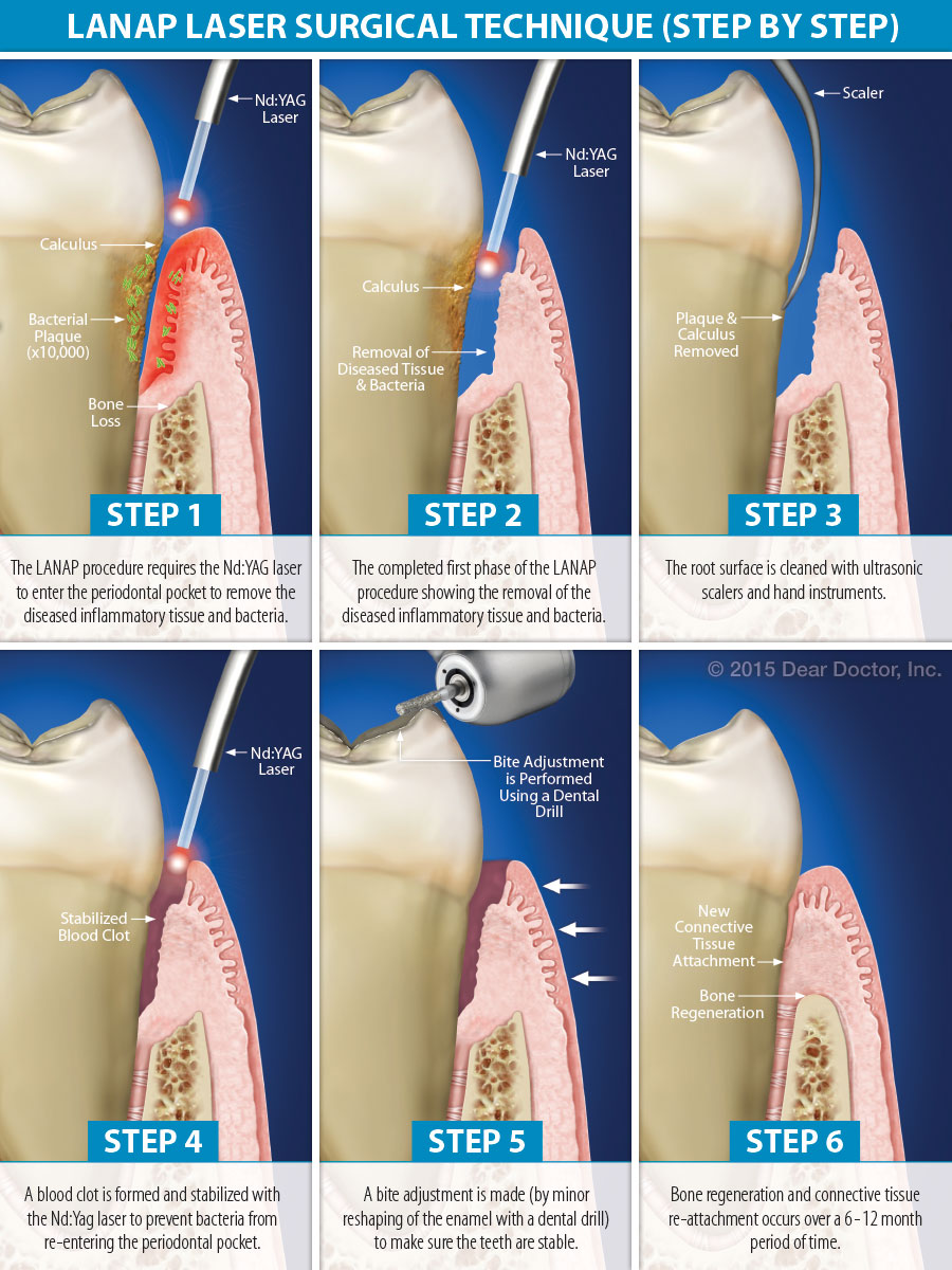 Latest Techniques in Treating Advanced Gum Disease