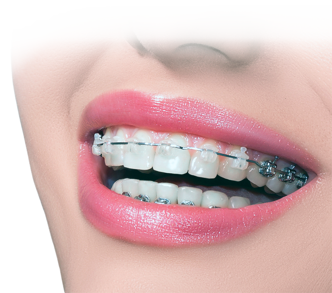 Orthodontic Solutions for Adults: It’s Never Too Late