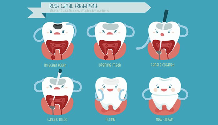 Pain After a Root Canal: Causes and Remedies