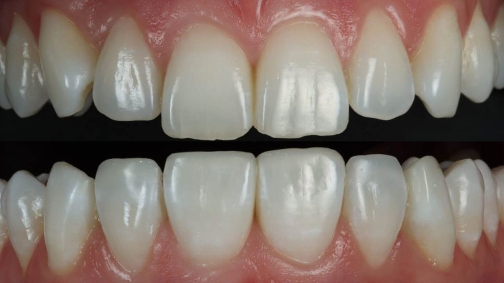 The Pros and Cons of Dental Bonding for Chipped Teeth
