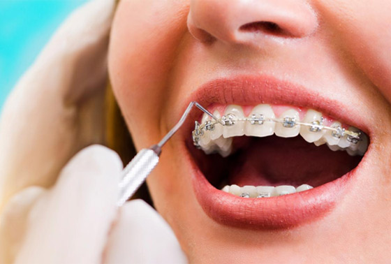 Understanding the Benefits of Accelerated Orthodontics