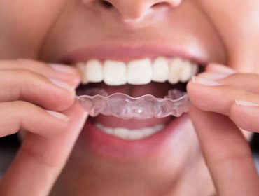 best clear aligners for overbite