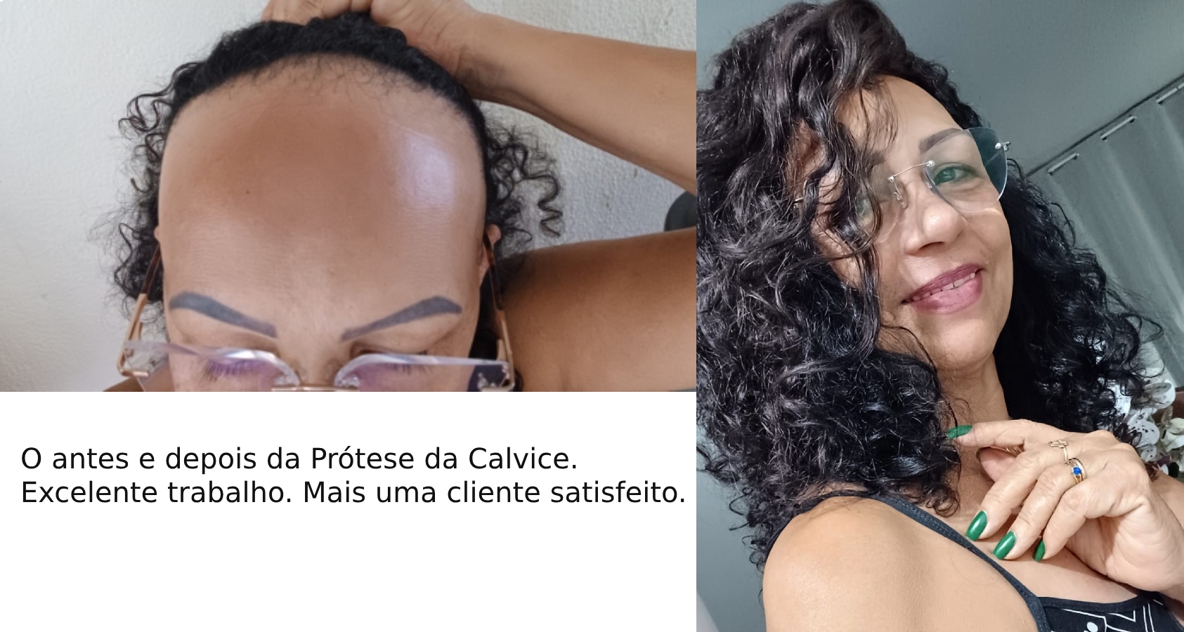 Promoção: Prótese de calvice feminina