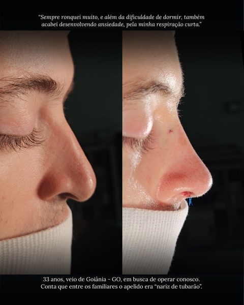 foto 1 de Dr. Bruno Alexandre - Rinoplastia | Natal