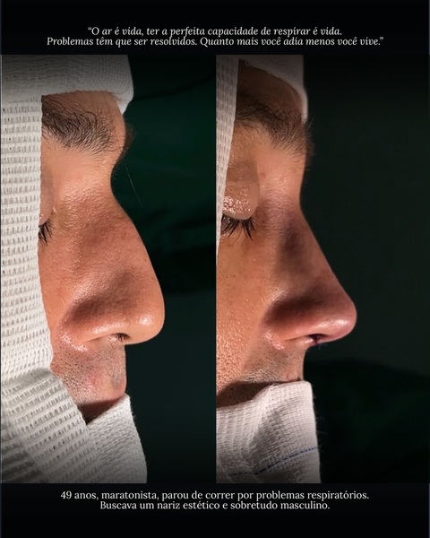 foto 2 de Dr. Bruno Alexandre - Rinoplastia | Natal