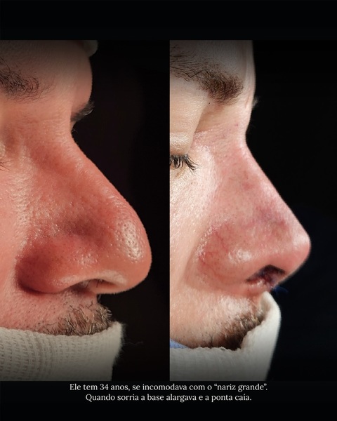 foto 3 de Dr. Bruno Alexandre - Rinoplastia | Natal