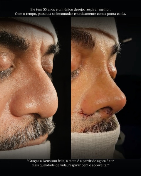 foto 4 de Dr. Bruno Alexandre - Rinoplastia | Natal