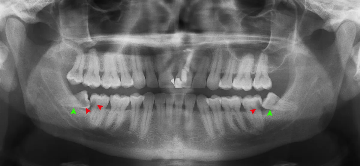 Wisdom Teeth 101: Why They Get Impacted