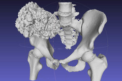 CT hip scan 33-percent